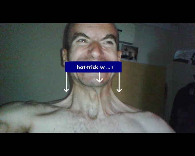 zdjęcie dziwnego tworu pod skórą szyi Tomasza Musielaka, konsekwencji tajnego eksperymentu na niewinnym człowieku